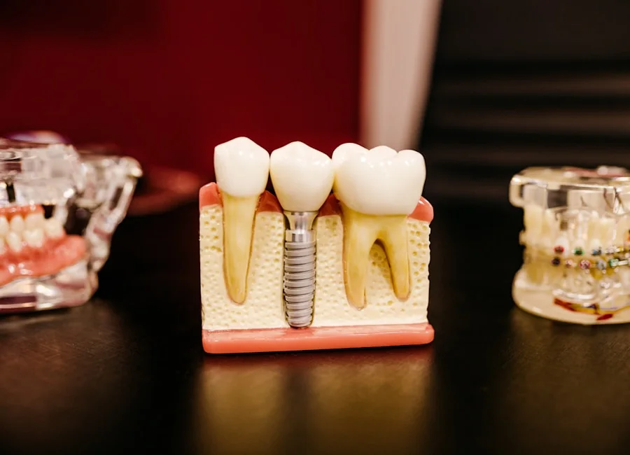 İmplant tedavisini açıklayan doğal diş ve implant modeli